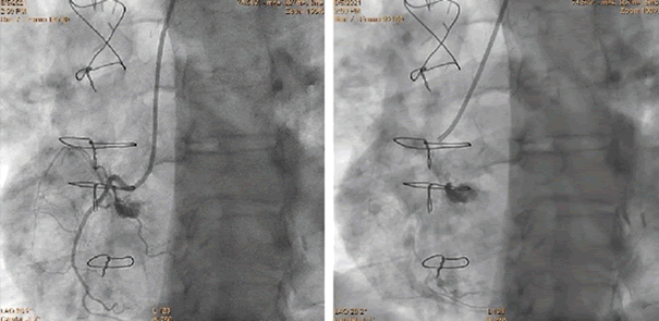 Interventional-Cardiology-Journal-55