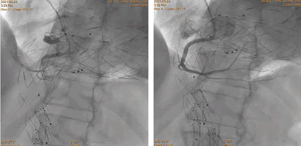 Interventional-Cardiology-Journal-66