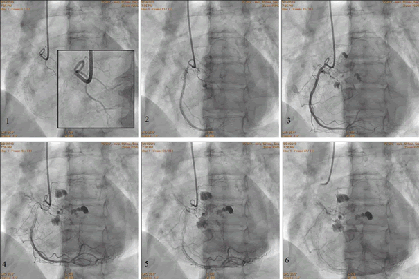 Interventional-Cardiology-Journal-Stages