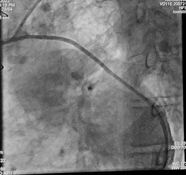 Interventional-Cardiology-Journal-Stenting