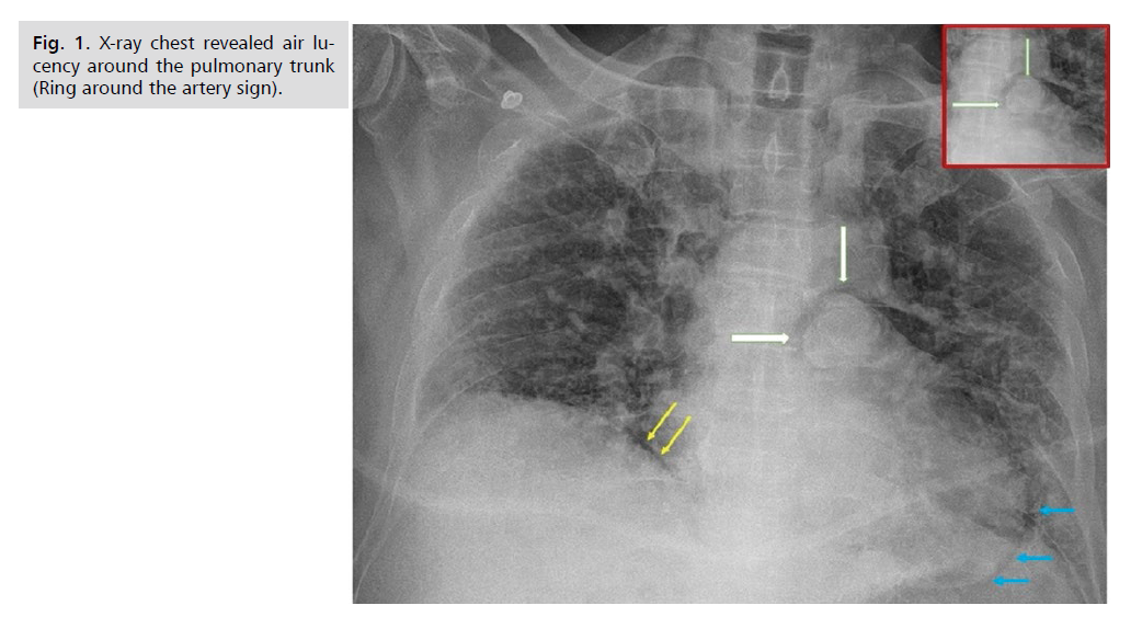 archives-medicine-pulmonary-trunk