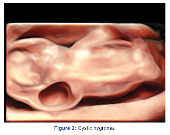 gynaecology-obstetrics-cystic-hygroma