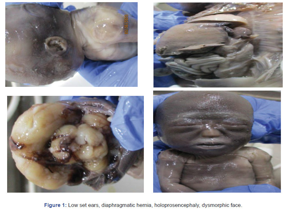 gynaecology-obstetrics-diaphragmatic-hernia