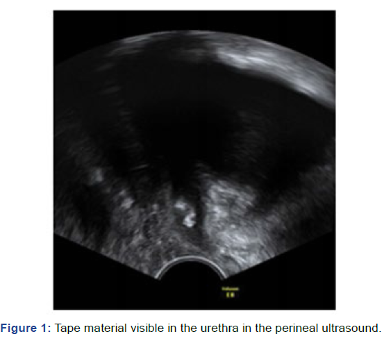 gynecology-obstetrics-case-report-perineal