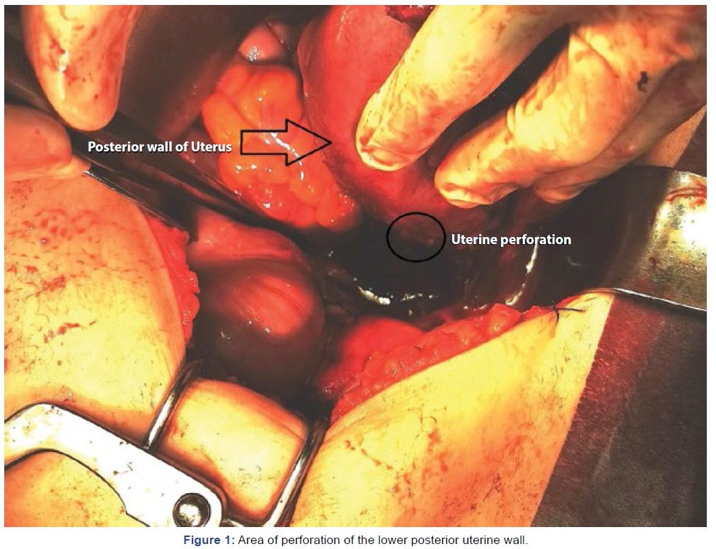 gynecology-obstetrics-case-report-uterine