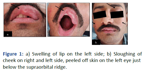 IPDEHC-Swelling
