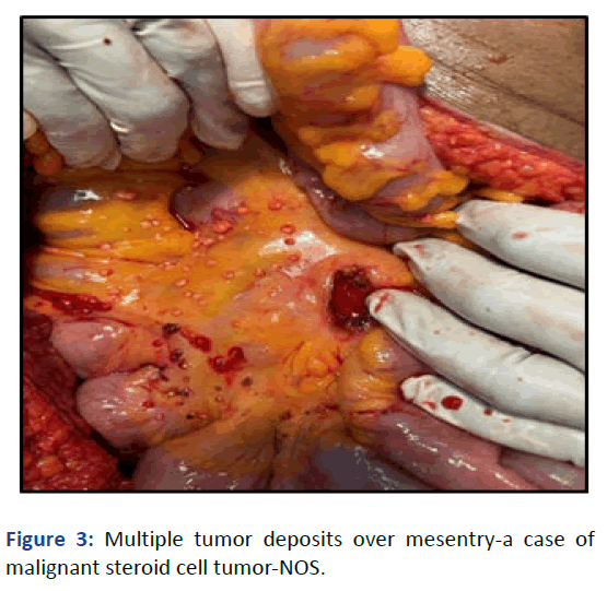 IPJCEP-tumor