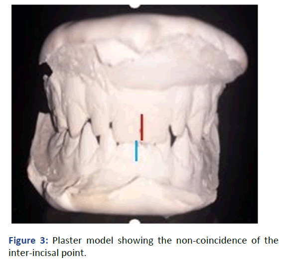 IPPDPD-Plaster