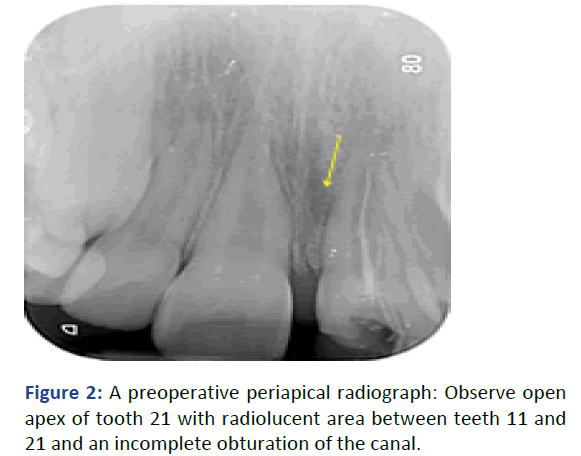 IPPDPD-periapical