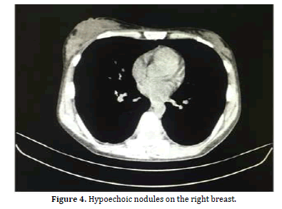 Pancreas-Hypoechoic