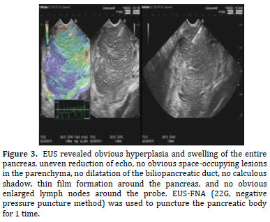 Pancreas-swelling