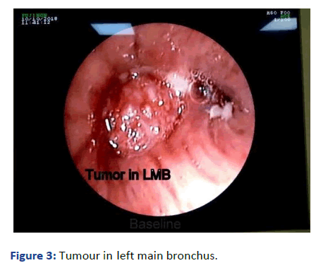 aasrfc-Tumour