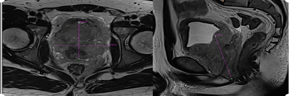 journal-oncology-prostate