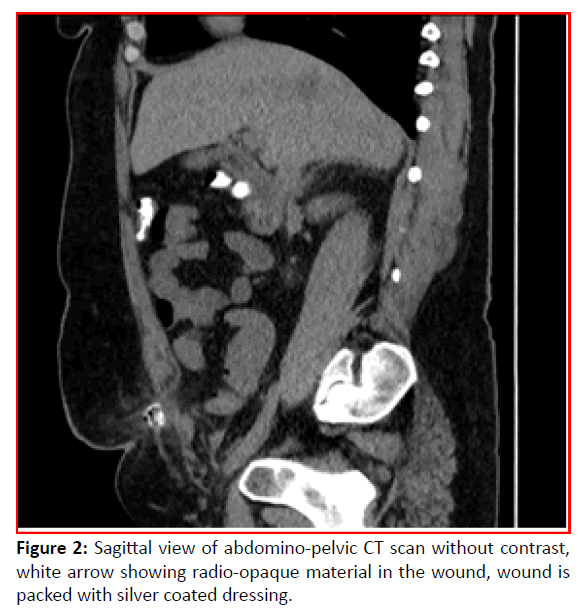 gynecology-obstetrics-case-report-abdomino-pelvic