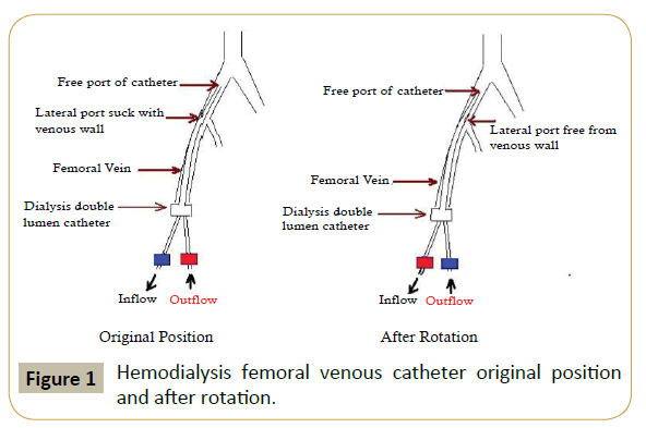 Femoral Dialysis Catheter