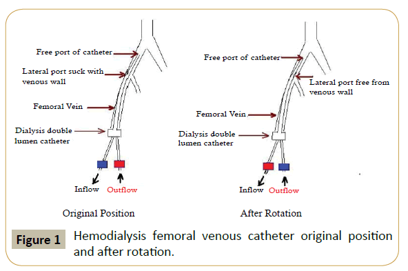 Femoral Venous Catheterization Nejm - vrogue.co