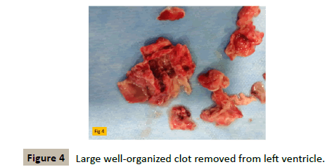 Interventional-Transthoracic-left-ventricle