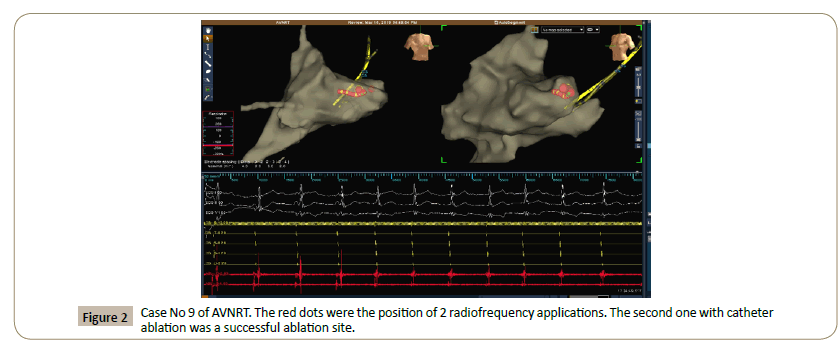 Interventional-Cardiology-radiofrequency-applications