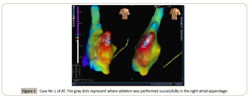 Interventional-Cardiology-right-atrial