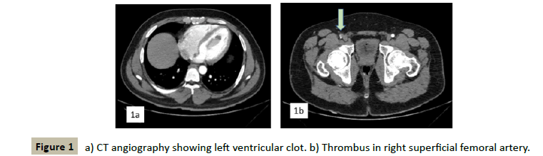 Interventional-Cardiology-ventricular