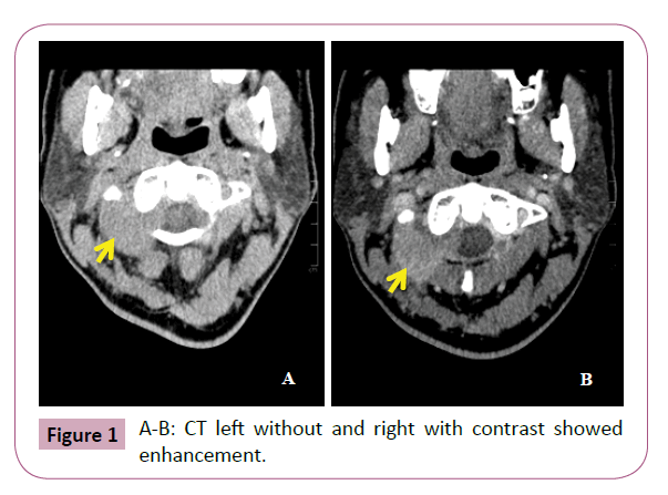 Neuro-Oncology-CT-left-without-and-right-with-contrast