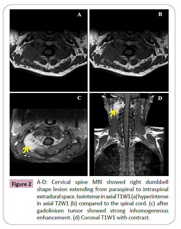 Neuro-Oncology-Cervical-spine-MRI-showed-right-dumbbell