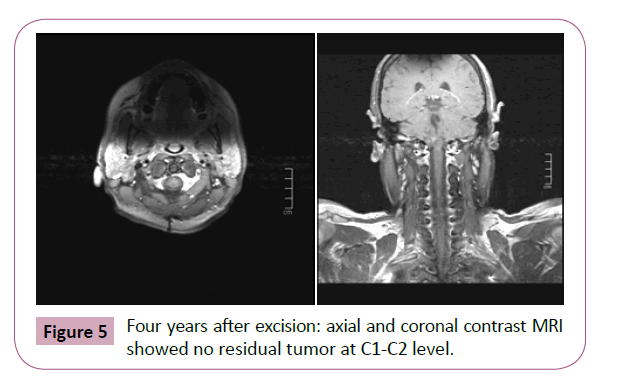 Neuro-Oncology-Four-years-after-excision-axial-coronal