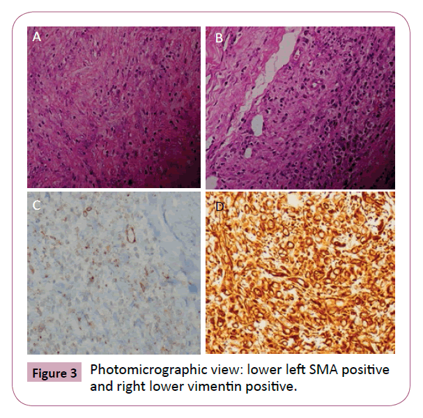 Neuro-Oncology-Photomicrographic-view-lower-left-SMA-positive
