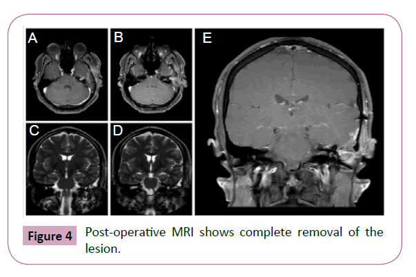 Neuro-Oncology-Pre-operative-MRI-shows-complete-removal