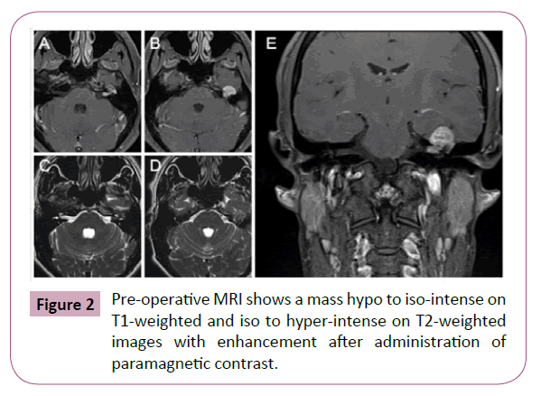 Neuro-Oncology-Pre-operative-mass-hypo-iso-intense