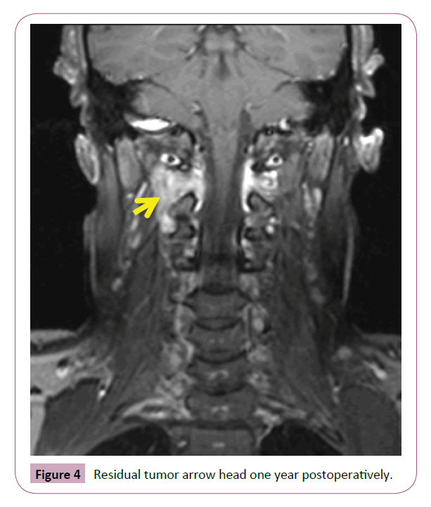 Neuro-Oncology-Residual-tumor-arrow-head-one-year-postoperatively