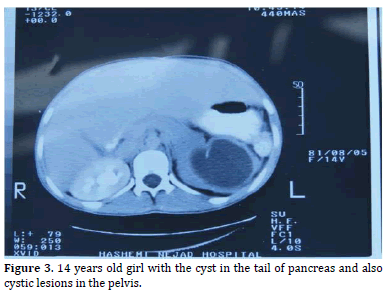 Pancreas-14-years-old-girl-with-cyst-tail