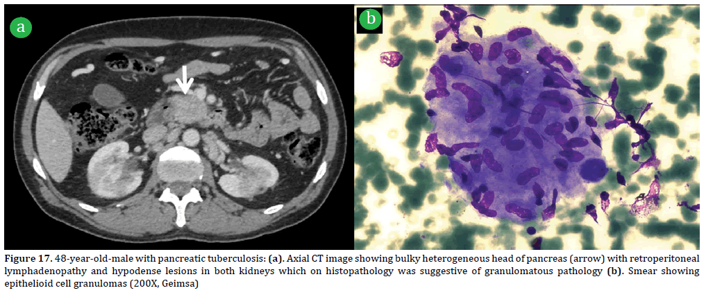 Pancreas-48-year-old-male-pancreatic-tuberculosis