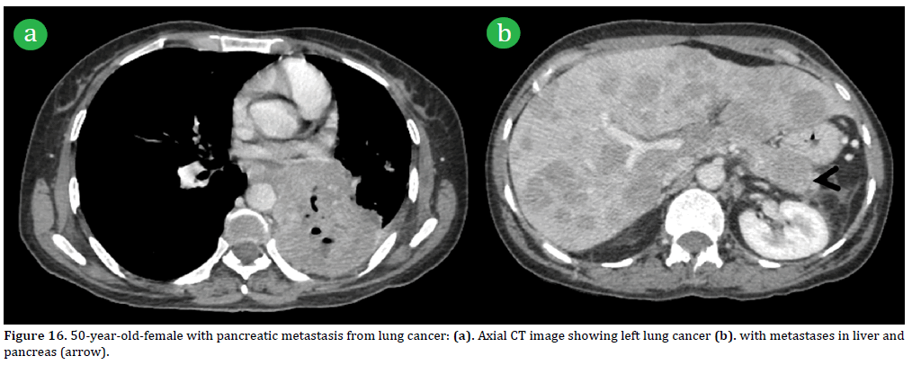 Pancreas-50-year-old-female-pancreatic-metastasis