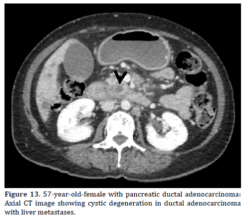 Pancreas-57-year-old-female-pancreatic-ductal