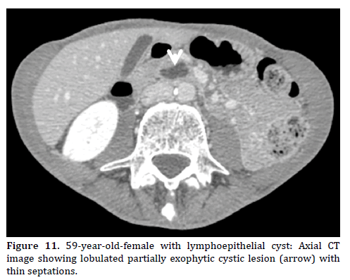 Pancreas-59-year-old-female-lymphoepithelial-cyst