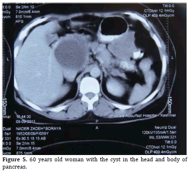 Pancreas-60-years-old-woman-with-cyst