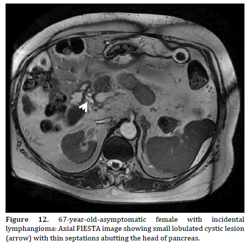 Pancreas-67-year-old-asymptomatic-female-incidental