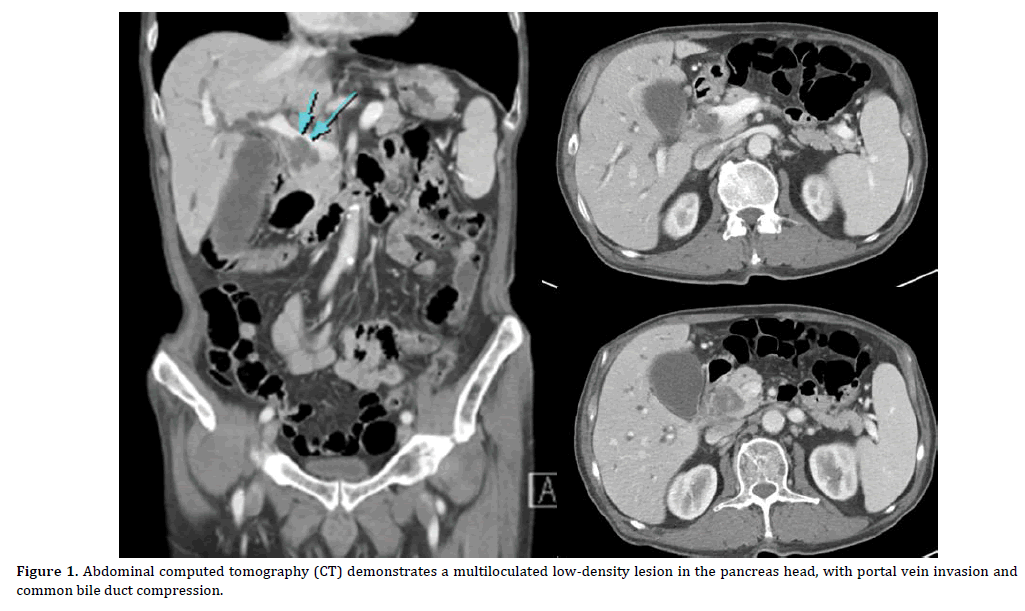 Pancreas-Abdominal-computed-tomography