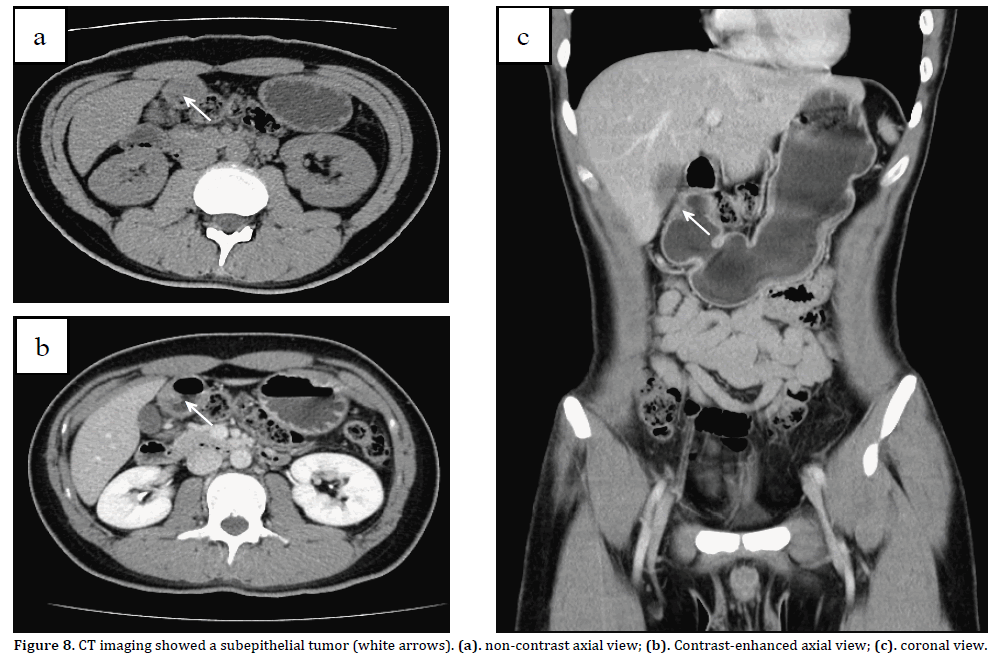 Pancreas-CT-imaging-showed-subepithelial