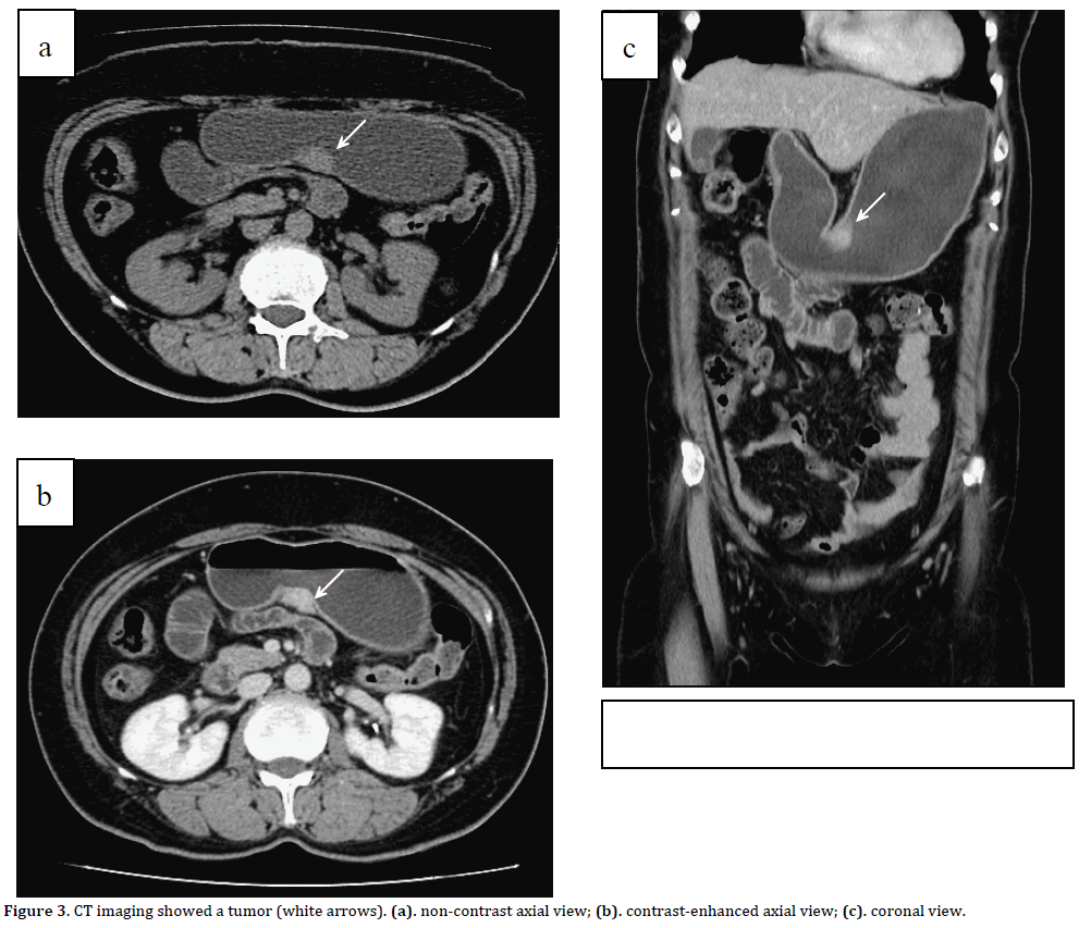 Pancreas-CT-imaging-showed-tumor