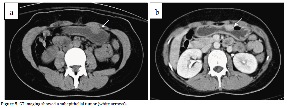 Pancreas-CT-imaging-subepithelial-tumor