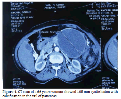 Pancreas-CT-scan-66-years-woman