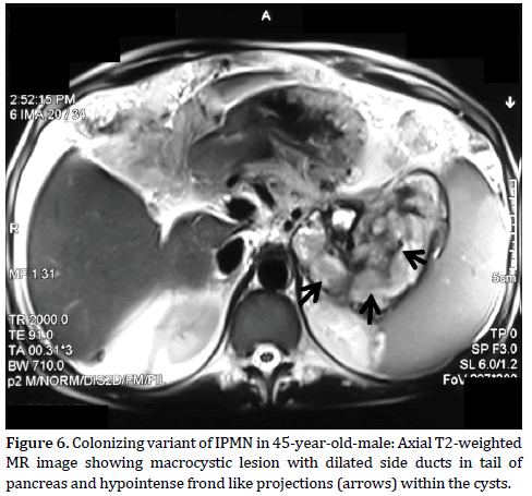 Pancreas-Colonizing-variant-IPMN-45-year-old