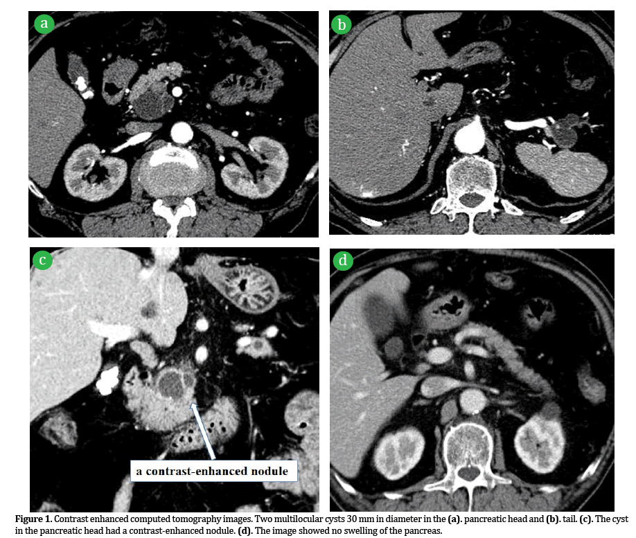 Pancreas-Contrast-enhanced-computed-tomography