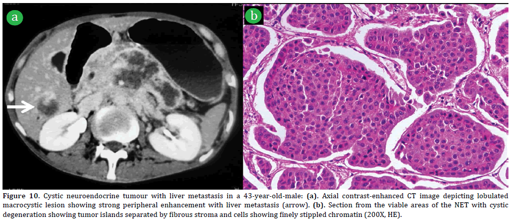 Pancreas-Cystic-neuroendocrine-tumour-liver