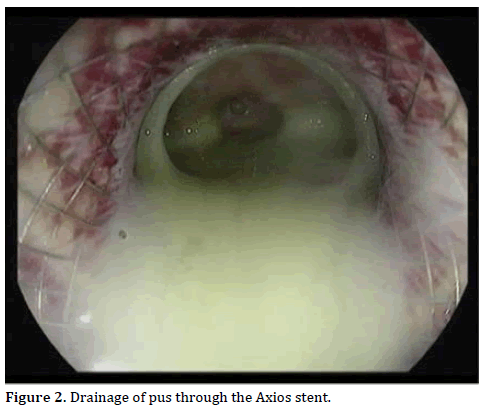Pancreas-Drainage-pus-Axios-stent