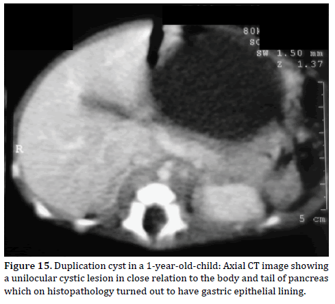 Pancreas-Duplication-cyst-1-year-old-child