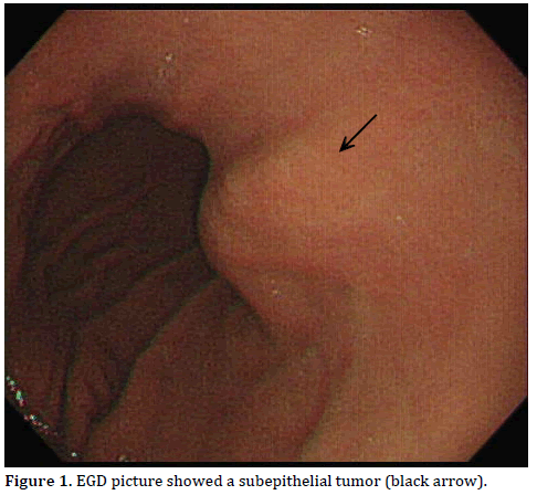 Pancreas-EGD-picture-subepithelial-tumor