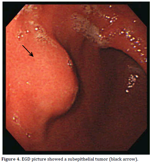 Pancreas-EGD-picture-subepithelial-tumor